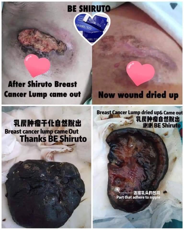 Shiruto Breast Cancer