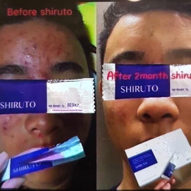 SHIRUTO 皮肤问题