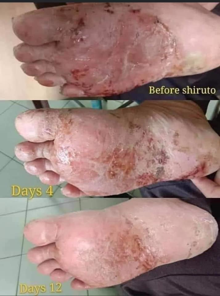 SHIRUTO 腳板細菌感染
