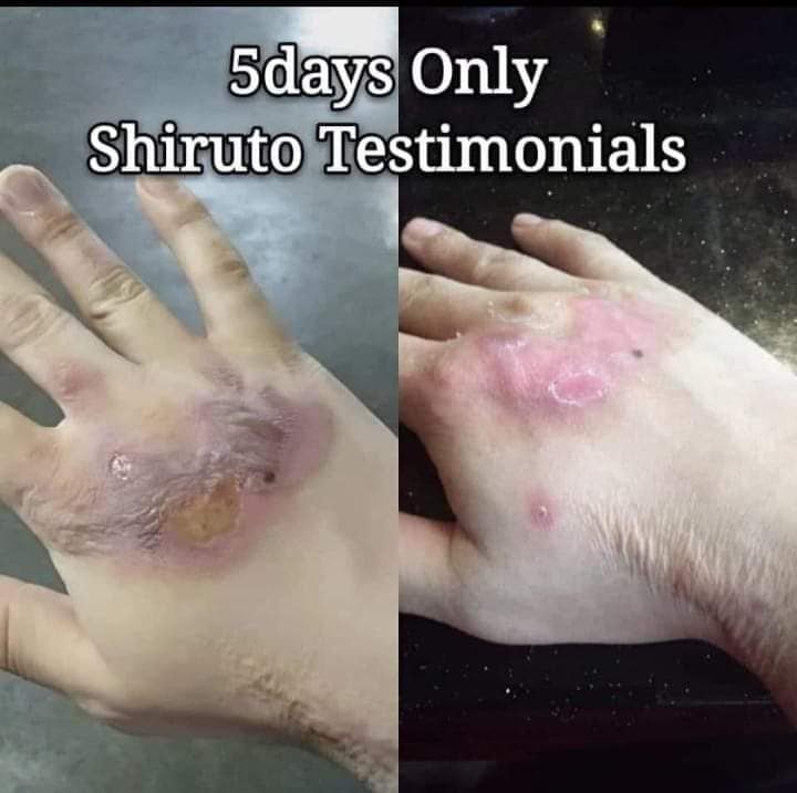 SHIRUTO 油烫伤手